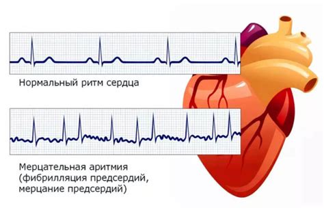 Предсердный ритм на ЭКГ: общая характеристика