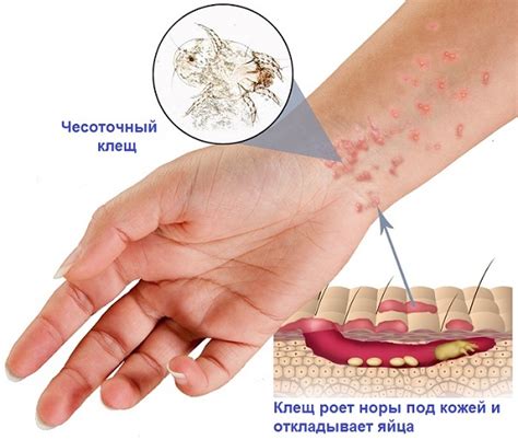 Признаки наличия чесоточного клеща