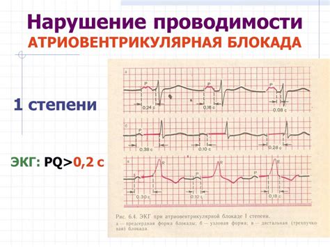 Причины нарушения метаболических процессов в миокарде на ЭКГ