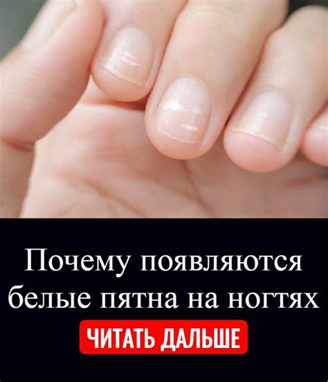 Причины потемнения на ногтях