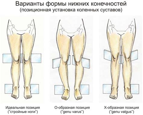 Причины развития иксообразного расположения нижних конечностей у взрослых