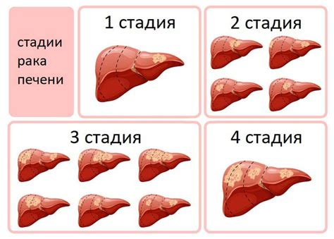 Причины развития опухоли в печени