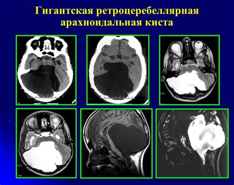 Прогноз после операции удаления арахноидальной кисты: долгосрочные результаты и перспективы пациента