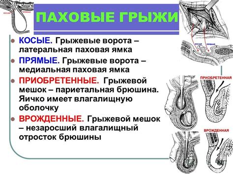 Профилактика возникновения грыжи в паху