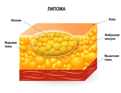 Профилактика жировиков на спине