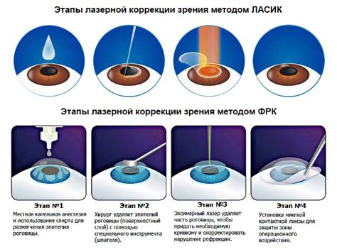 Процесс лазерной коррекции зрения