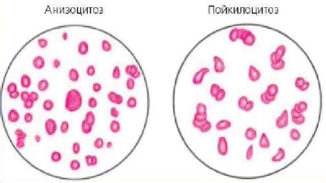 Проявление пойкилоцитоза