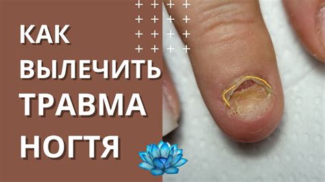 Псориаз поражает ногтевую пластину, вызывая ее утолщение