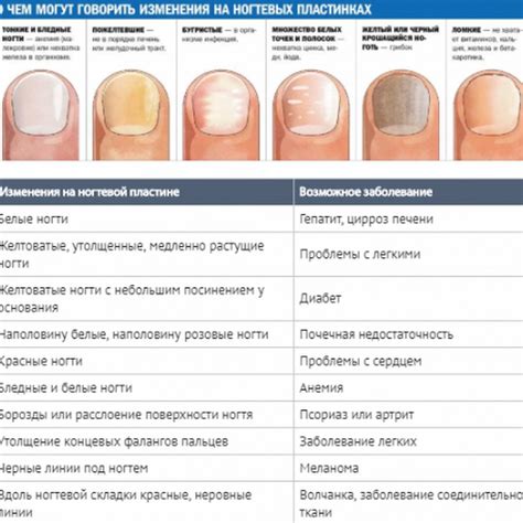 Раннее распознавание и диагностика гниения ногтевой пластины