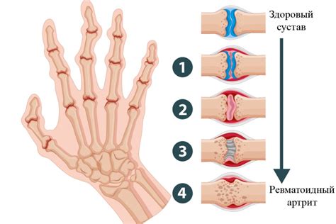 Ревматоидный артрит указательного пальца