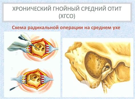 Рекомендации по лечению гнойного отита: основные моменты