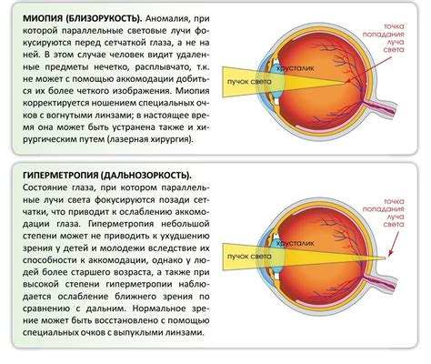 Самостоятельное определение дальнозоркости