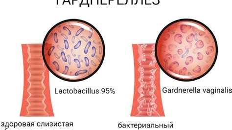 Симптомы гарднереллы у мужчин