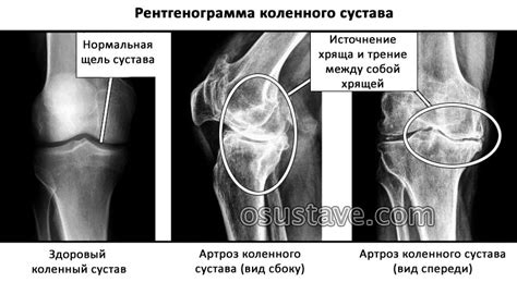 Симптомы наростов в коленном суставе