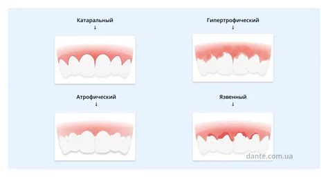 Симптомы опухшей десны