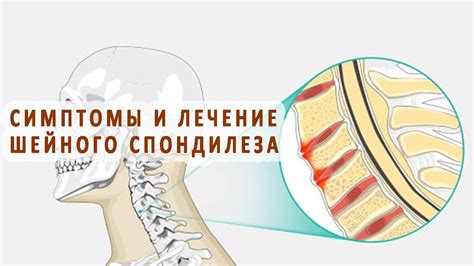 Симптомы спондилеза