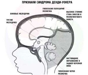 Синдром Денди-Уокера у взрослых