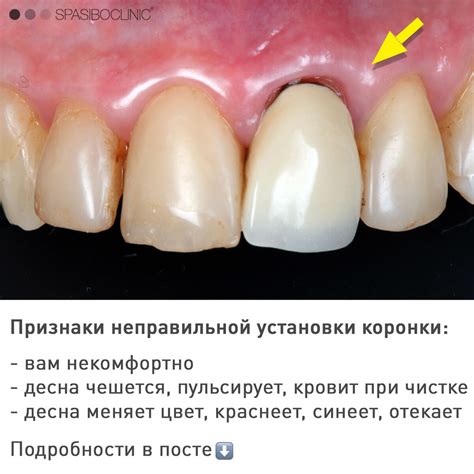 Следствия неправильной приклеивания коронки