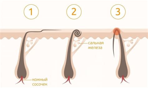 Снижение риска вросших волос