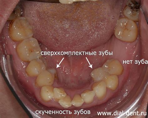 Снижение уровня комфорта в повседневной жизни при наличии несовершенного прикуса