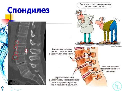 Спондилез позвоночника