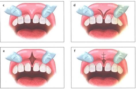 Способы лечения нароста на уздечке верхней губы