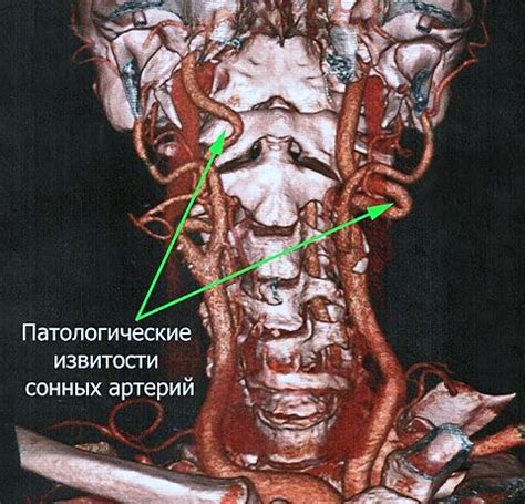 Способы лечения нарушения хода ВСА с обеих сторон