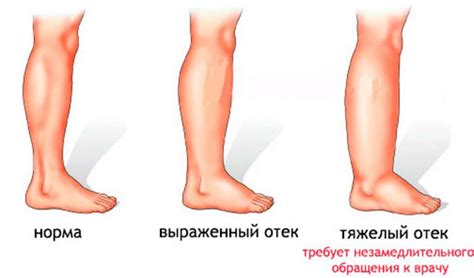 Способы устранения отека ног при менструации