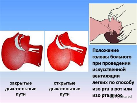 Спутанная позиция: важность положения головы при механической вентиляции легких