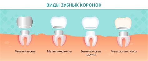 Сталики для коронок: что выбрать?