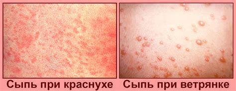 Сыпь при повышении температуры: причины и проявления