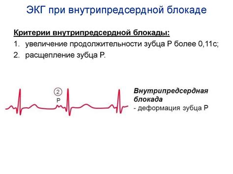 Типы нарушения внутрижелудочковой проводимости