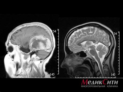 Травмы и ушибы головного мозга