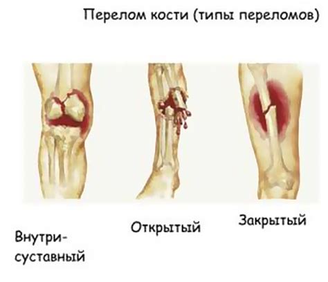 Травмы придавленного человека