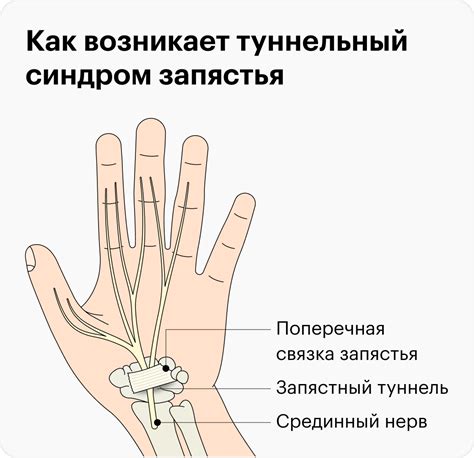 Туннельный синдром запястья: поражение нервов