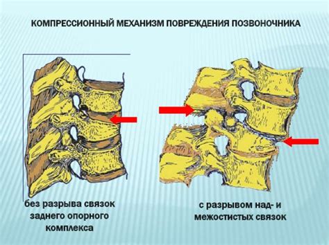 Укрепление связочного аппарата