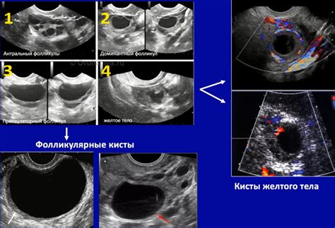 Функциональные нарушения яичников и их воздействие на нижнюю часть спины