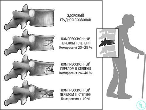 Частые причины переломов