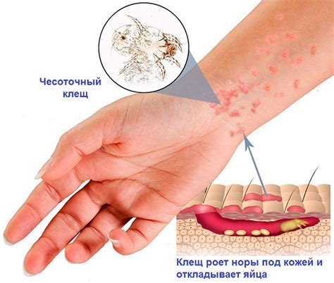 Чесотка и паразиты как источник зуда