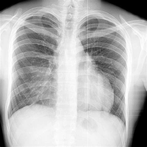 Что такое тень сердца на рентгене?
