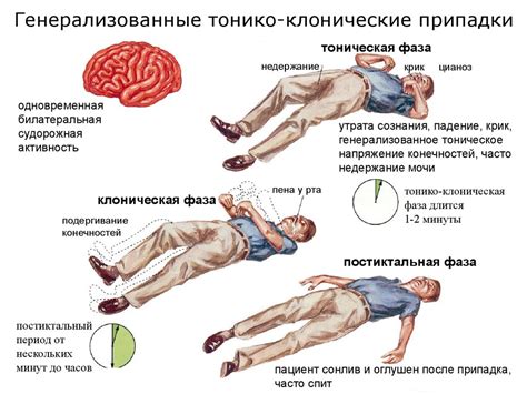 Эпилепсия: симптомы и причины