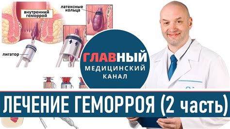 Эффективное лечение геморроя с ректальной насадкой Дарсонваль