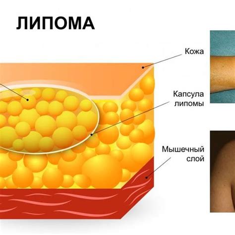 Эффективное лечение шариков под кожей