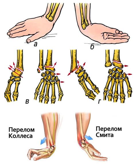 Эффективность гипса при травме