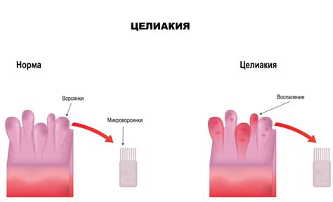 Эффективные методы лечения нароста на ребре у взрослых