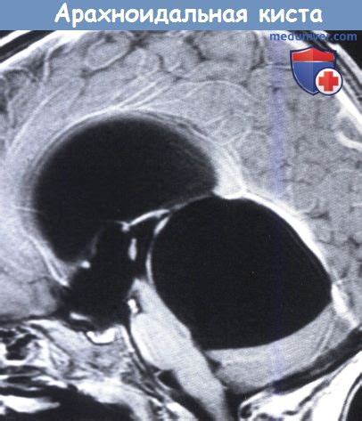  Арахноидальная киста в голове: основные характеристики и причины возникновения 