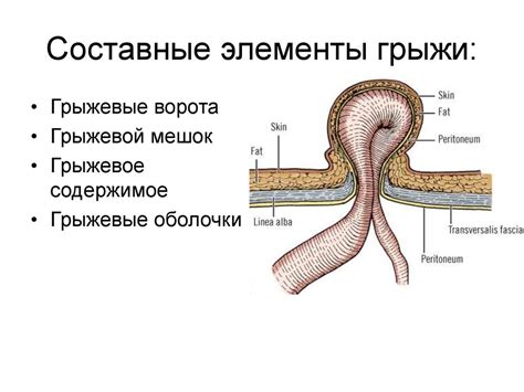  Типичные проявления грыжи на передней части живота
